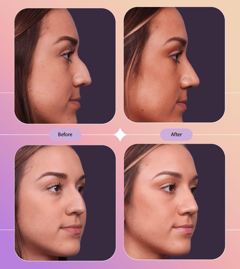 Novomed Plastic Surgeon Dubai Rhinoplasty BBL Liposuction Gynecomastia Tummy tuck Facelift Breast body lift Butt filler Botox 3
