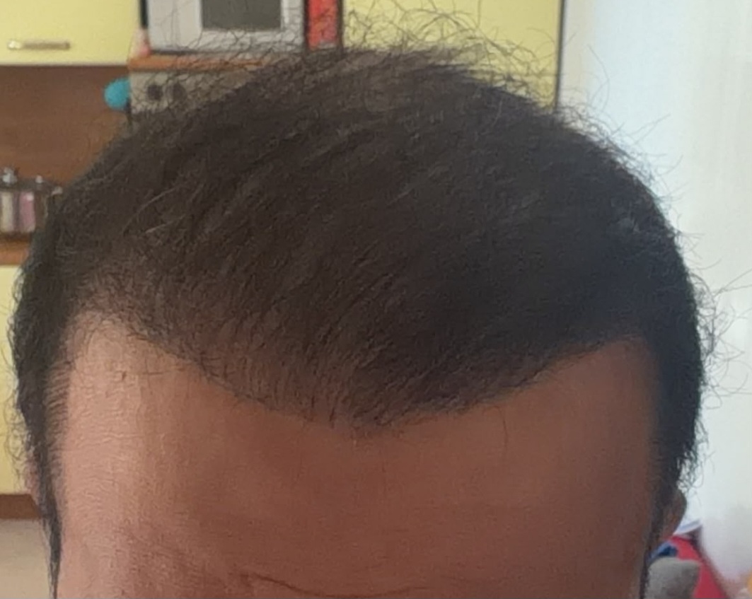 Glamorous Hair Transplant in Dubai | Glam Hair Clinic - FUE Hair Transplant Dubai, FUT Transplant, BioFibre, DHI 5