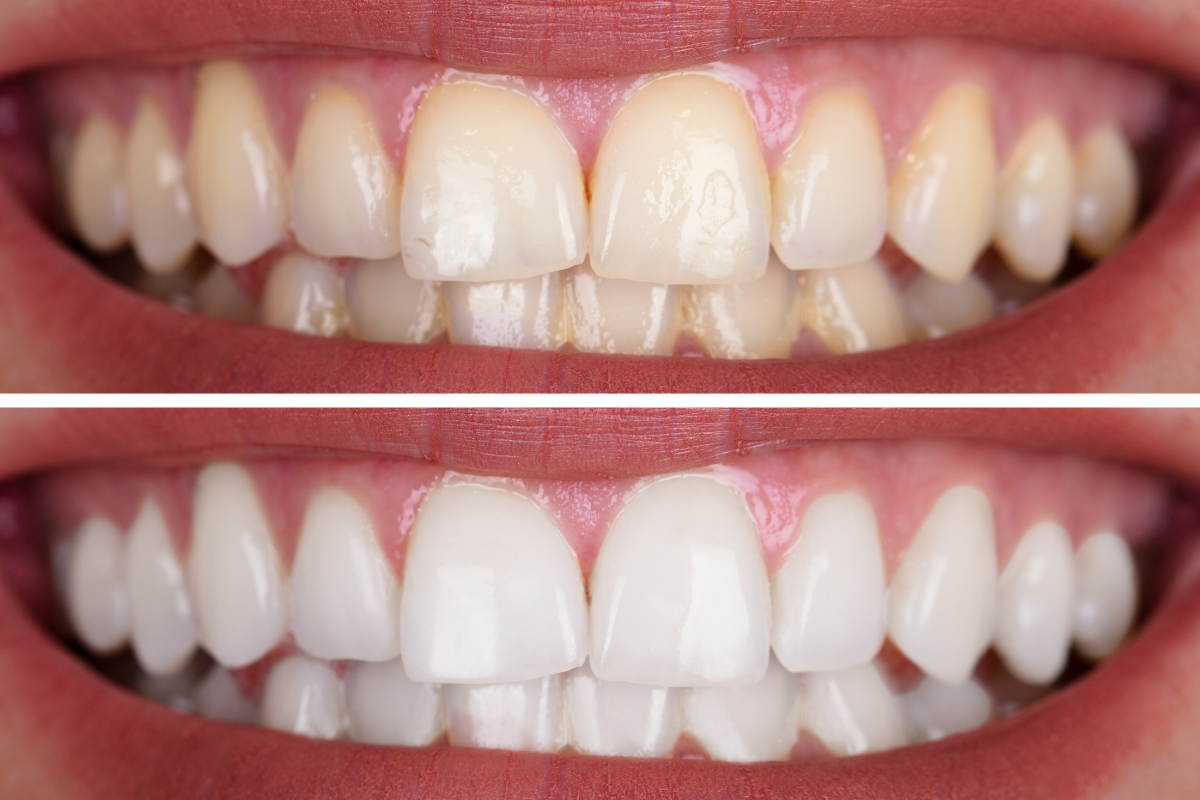 Tooth-Tastic 2