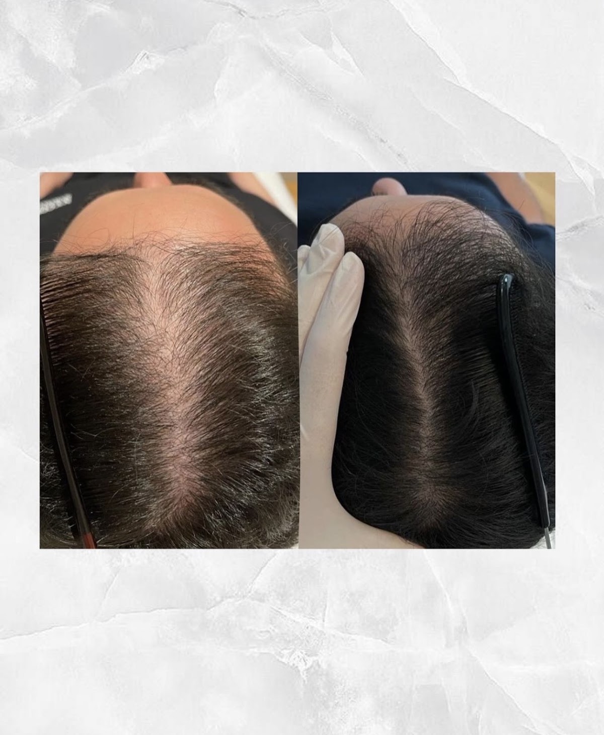 LEJOU DUBAI PRP HAIR