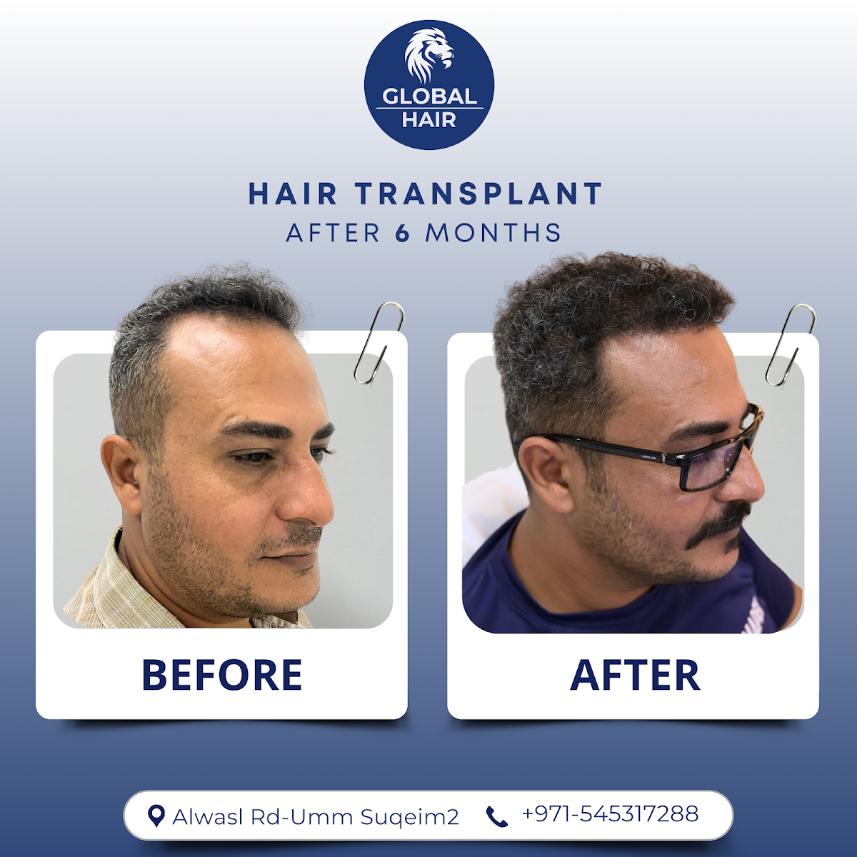 Global Hair Centre Dubai 3