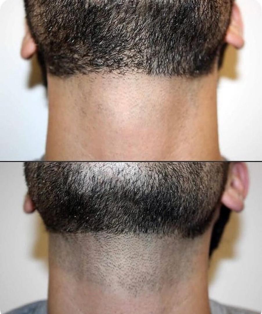 Laser One Clinic | Laser Hair Removal Business Bay Dubai 5