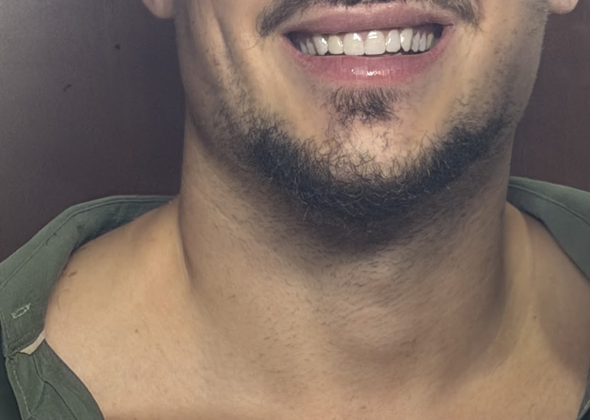 Lumen Smile 5