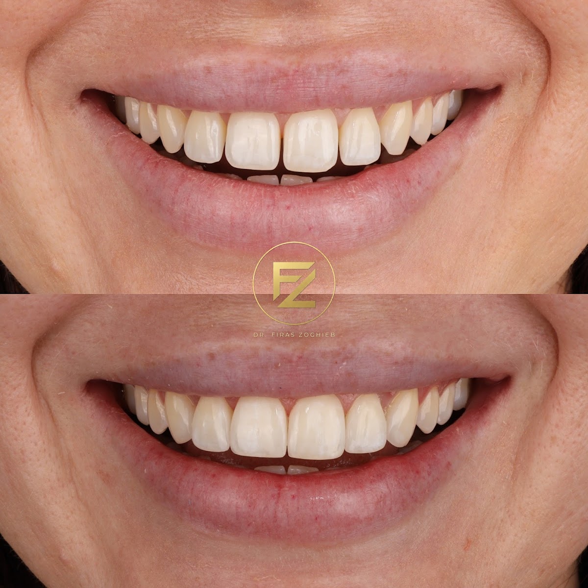 Dr. Firas | Composite Bonding - Dubai 2