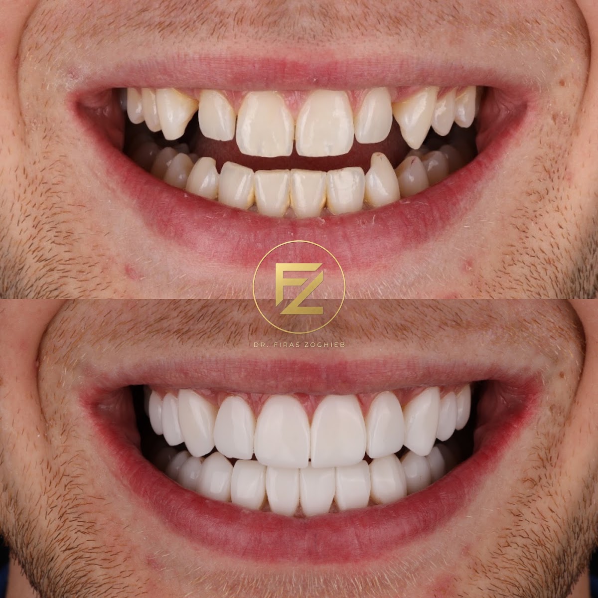 Dr. Firas | Composite Bonding - Dubai 3
